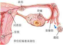 输卵管积水是怎么回事 输尿管积水是怎么回事 输卵管积水是怎么回事