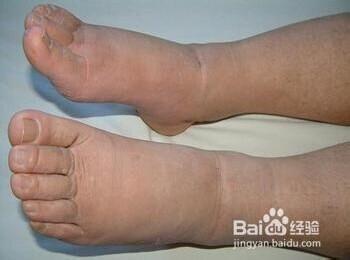 特发性水肿中医治疗 特发性水肿中医治疗 中医4招治疗肾性水肿