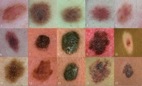 良性黑色素瘤的症状 黑色素瘤早期症状是什么?