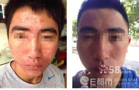 严重痤疮的治疗方法 痤疮根治方