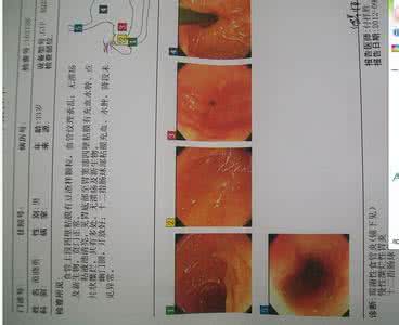 大蒜治疗霉菌性食道炎 霉菌性食道炎 传统治疗霉菌性食道炎