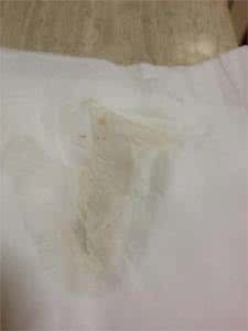 怀孕初期白带症状图片 怀孕初期白带症状