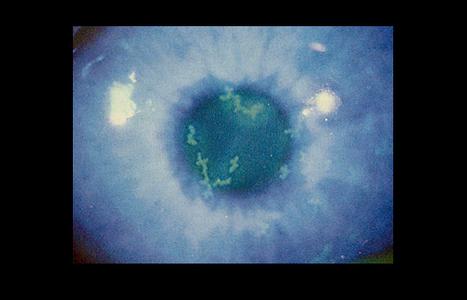 全球艾滋病感染人数 全球2/3的50岁以下人染有1型单纯疱疹病毒