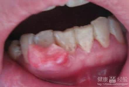 牙肉肿痛怎么办 牙肉肿痛怎么办 轻松治疗牙肉肿痛