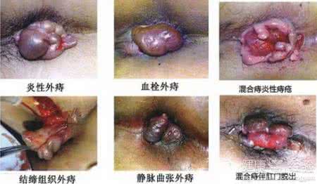 痔疮的典型症状 痔疮发病前的典型症状