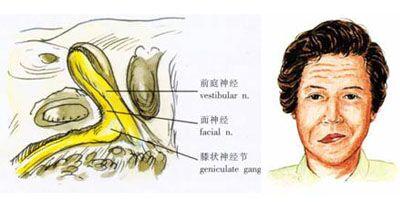 神经性耳痛的原因 三叉神经痛,神经性耳痛,面瘫的原因,如何治疗