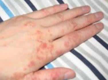 皮肤湿疹偏方 图文：治疗皮肤湿疹简便外用偏方