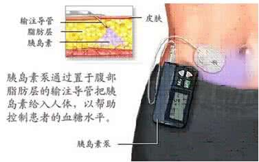 糖尿病胰岛素泵价格 胰岛素泵或降低1型糖尿病患者心血管风险