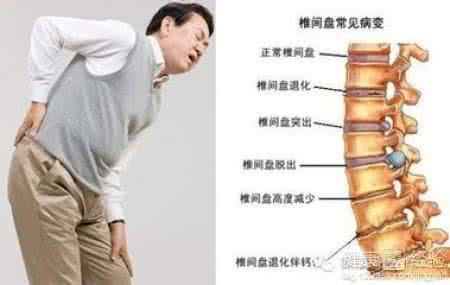 治疗腰间盘突出怎么办 治疗腰间盘突出 腰间盘突出怎么办