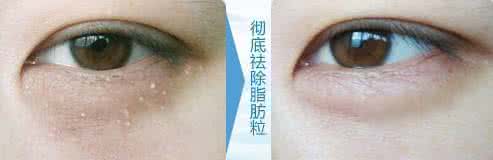 激光去脂肪粒多少钱 激光去脂肪粒多少钱 脸上起脂肪粒怎么办？