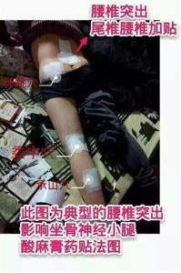 腰间盘脱出的治疗方法 腰间盘脱出怎么治疗好 腰间盘脱出治疗方法，用什么膏药好
