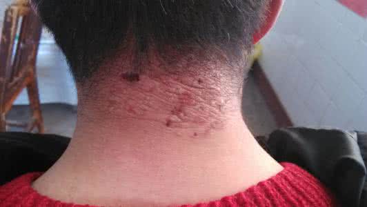 神经性皮炎的治疗 神经性皮炎的治疗 神经性皮炎的中西医治疗