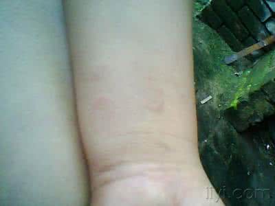 慢性荨麻疹吃什么药 慢性荨麻疹怎么治疗 慢性荨麻疹不能吃什么