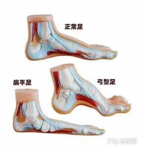 小孩扁平足图片 小孩扁平足图片 小孩扁平足该怎么办呢?