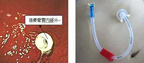 脑梗塞最佳治疗药物 药物与性:乱用壮阳药可导致脑梗塞