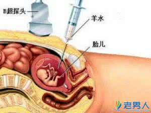 为什么要做羊水穿刺 为什么做羊水穿刺？