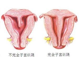 子宫纵膈影响生育吗 纵膈子宫分左右吗？