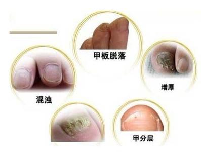 吃药治疗灰指甲 治疗灰指甲非要吃药吗 吃药治疗灰指甲