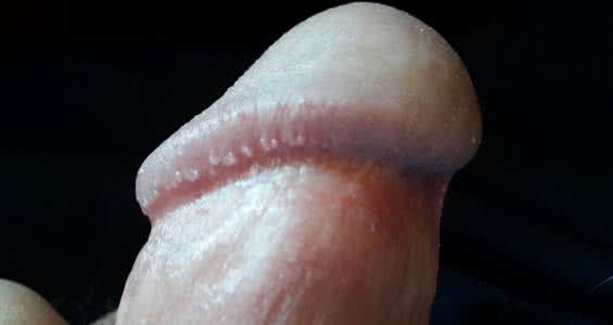 女性淋病有什么症状 淋病 淋病有什么症状