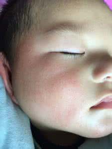 宝宝出疹子可以洗澡吗 出疹子可以哺乳吗？