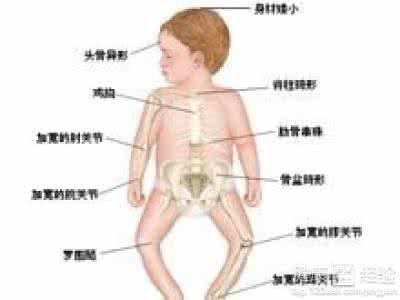 佝偻病病因 佝偻病的病因 引起佝偻病的5个原因