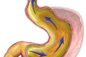 胆汁返流性胃炎 治养兼顾 摆脱返流性胃炎