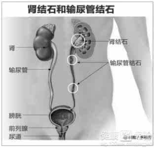 肾结石输尿管结石 转载 “石通草”治疗肾结石、输尿管结石、