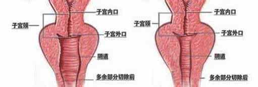 阴紧缩术 阴道缩紧 能用多久 阴道缩紧的锻炼方式