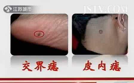 万家灯火 20150908万家灯火视频和笔记:张书元,老年斑,白癜风,黑色素瘤