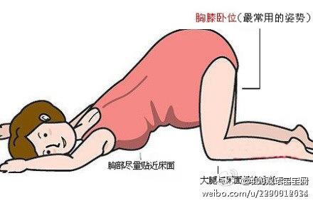 胎儿臀位怎么纠正 胎儿臀位怎么纠正 “十臀九女”是真的吗？胎儿臀位该如何纠正