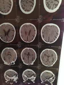 腔隙性脑梗死会痊愈吗 名医秘方：脑梗死脑萎缩一月痊愈神方