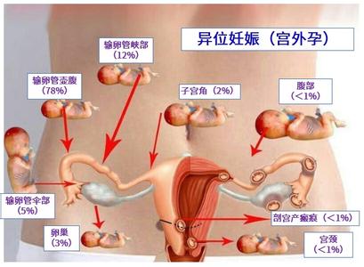 宫外孕发生的原因 宫外孕发生的原因 警惕发生宫外孕的四个原因