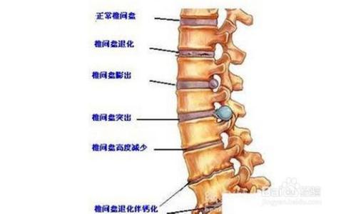 颈椎骨质增生的小偏方 颈椎骨质增生的原因