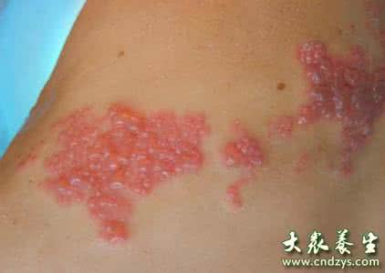 带状疱疹中药外敷秘方 带状疱疹特效秘方【转载】