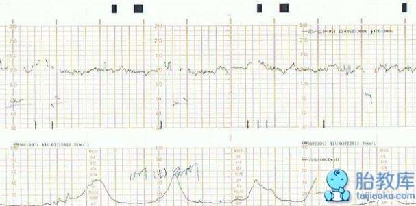 宫缩图怎么看就快生了 胎心监护图怎么看宫缩