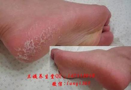 脚上股骨头坏死怎么办 人老脚先老，除脚上的坏死老皮、老茧就会容光焕发啦！