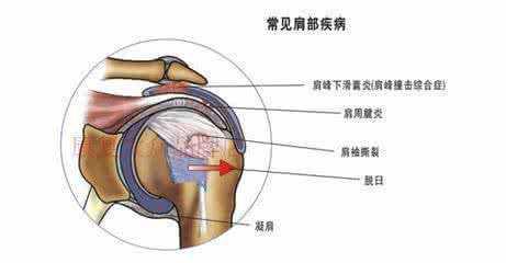 偏瘫患者下肢康复视频 治疗“下肢偏瘫”的奇穴——隐白穴 