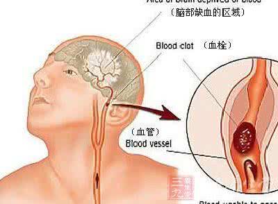 脑血栓形成的原因 脑血栓形成的原因 了解脑血栓形成
