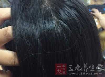 头顶长白发是什么原因 长白发怎么办？按摩头顶1个穴位，白发重新变黑！