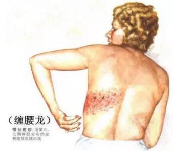 缠腰龙会死人吗 缠腰龙会死人吗 恐怖的“缠腰龙”到底是什么鬼？真能缠死人？