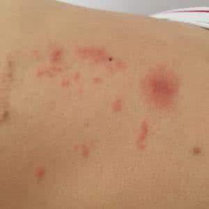 孕妇被蚂蚁咬又痒又肿 孕妇被蚂蚁咬了怎么办