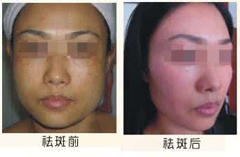 光子嫩肤去斑价格 光子嫩肤去斑价格 光子嫩肤祛斑价格