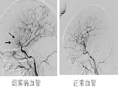 烟雾病的早期症状 烟雾病是什么 烟雾病的症状和治疗方法