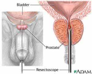 做前列腺肥大手术 前列腺肥大 前列腺肥大的时候应该怎么做