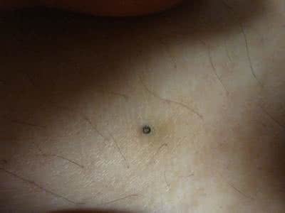 腿上的毛孔都变成黑点 腿上毛孔变黑怎么办？