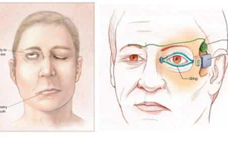 中枢性面瘫的表现是 周围性面瘫 这些表现就是周围性面瘫