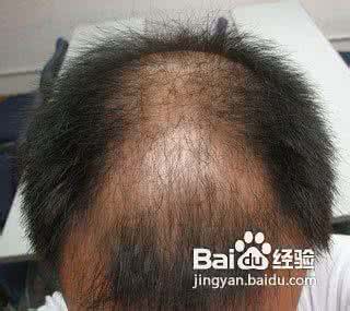 治疗脱发方法有哪些 治疗脱发有哪些方法 哪些方法可以治疗脱发