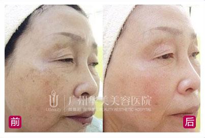 去除老年斑的方法 去除老年斑的方法 详解去除老年斑的方法
