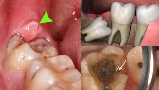 来月经可以补牙齿吗 来月经了可以拔牙齿吗？