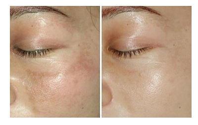 激光祛斑效果好吗 水光针 激光祛斑的效果好吗？